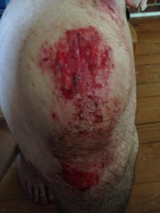 Knee from front